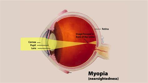 Nearsightedness