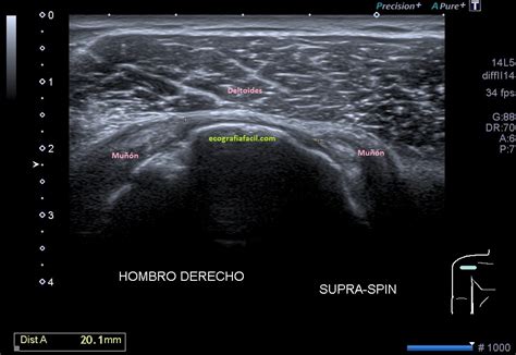 Tendón Supraespinoso Ecografía Fácil