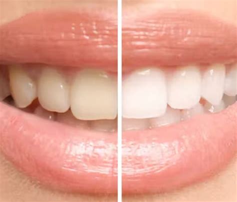 A Guide To Lightroom Teeth Whitening Retouching Labs