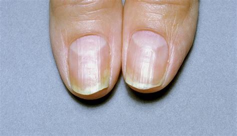 What Are Your Nails Saying About Your Health Nail Ridges Healthy