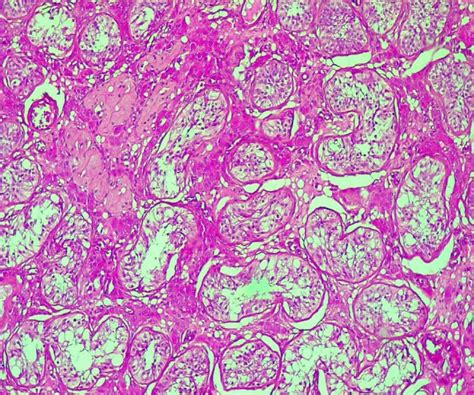 Ovotesticular Disorder Of Sex Development In A 46 XY Adolescent A Rare Case Report With Review