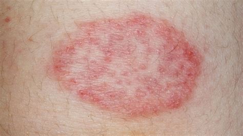 Ringworm Tinea Corporis What It Looks Like Causes And Treatment Rash