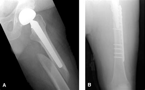 Figure From Total Hip Arthroplasty Periprosthetic Femoral Fractures