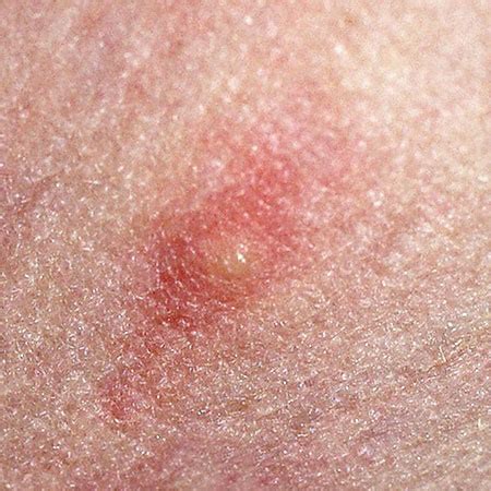 Chiggers Rash Spreading