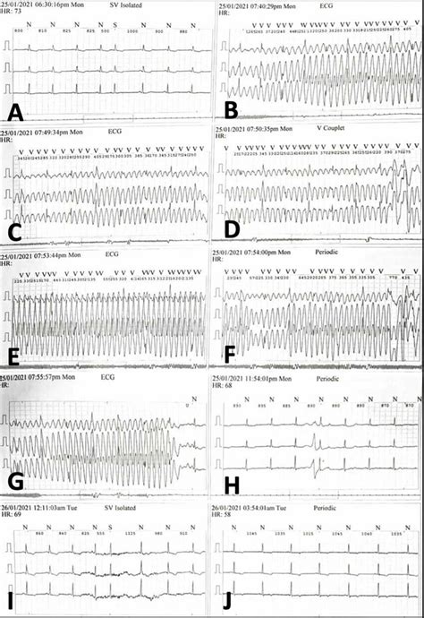 10 Second Captures From A 24 Hour Holter Monitoring Trace Showing A Download Scientific Diagram