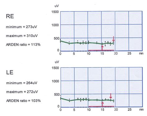 Electrooculography Changes Are Characteristic Of Severe Chorioretinal