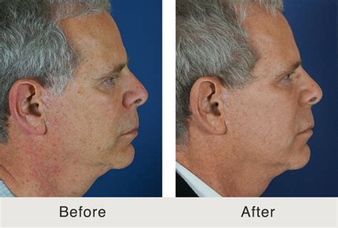 Before After Male Filler Temples Tear Trough Cheeks And Lips