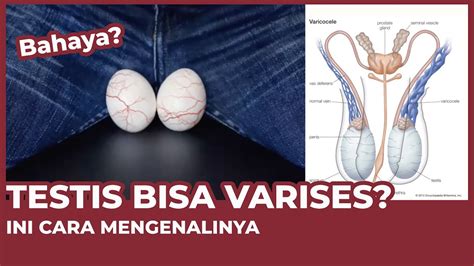 Couple Clinic Testis Bisa Varises Bikin Mandul Ini Penjelasannya