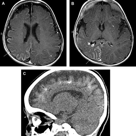 Imaging Of Vascular Malformations Radiology Key