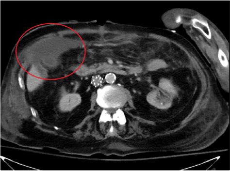 Ct Abdomen And Pelvis With Oral And Iv Contrast Showing Right