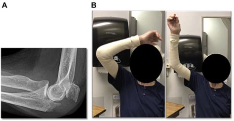 Outcomes Of Nonoperative Management Of Displaced Olecranon Fractures In