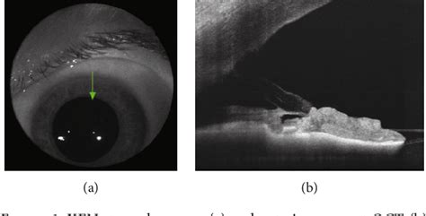 Figure 1 From Iris Occlusion Of XEN Gel Stent Following Ab Externo