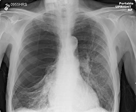 Loculated pneumothorax | Radiology Reference Article | Radiopaedia.org