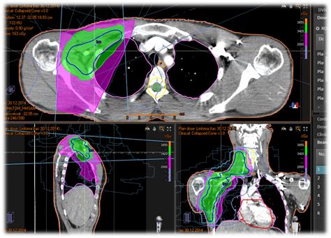 Linfomas Y Tumores Hematol Gicos Radioterapia Hm