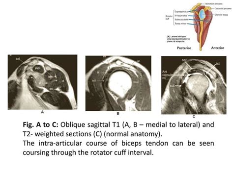 Mri Shoulder Joint With Common Pathologies Ppt