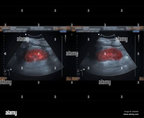 Ecograf A Del Abdomen Superior Que Muestra El Ri N Para La Detecci N