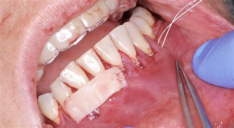 Maestr A En Periodoncia Y Cirug A Mucogingival