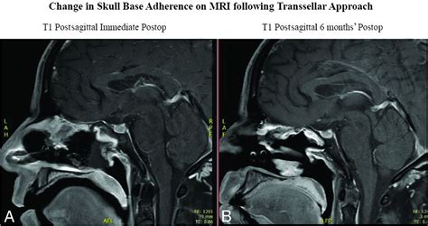 Evolution Of Radiographic Changes Of A Vascularized Pedicled Nasoseptal