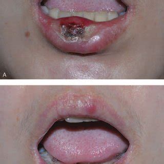 PDF Syphilitic Chancre Of The Lips Transmitted By Kissing A Case