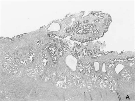 Ovarian Endometrioid Tumor Semantic Scholar