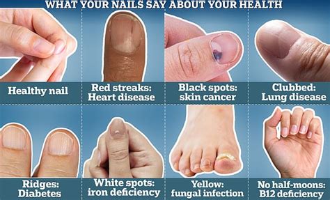 Zinc Deficiency Symptoms Fingernails Pictures Fingernail Health Chart ...