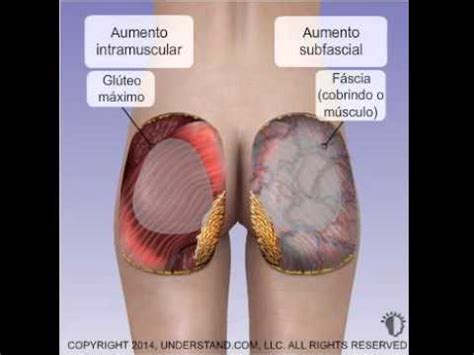 Gluteoplastia Prótese de Glúteos YouTube