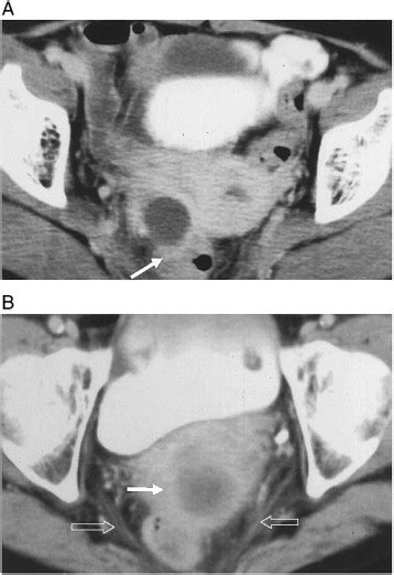 Tubo Ovarian Abscess Ct And Pathological Correlation Clinical Imaging