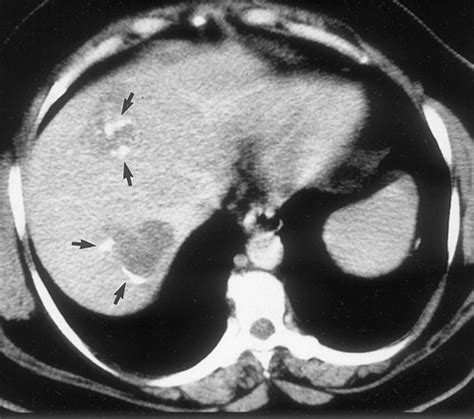 Cystic Focal Liver Lesions In The Adult Differential CT And MR Imaging