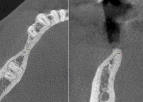 Preoperative CBCTscan Showing The Lower Jawaxial And Parasagittal