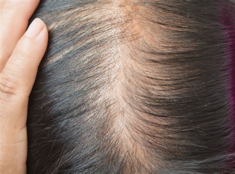 How To Treat Hair Loss Caused By Trauma Female Hair Loss Advice