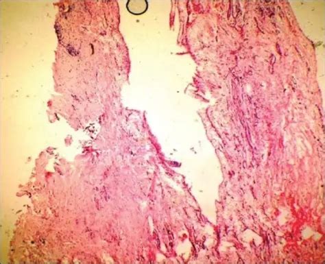 What is a Gingival Cyst of an Adult? - Pathosomes