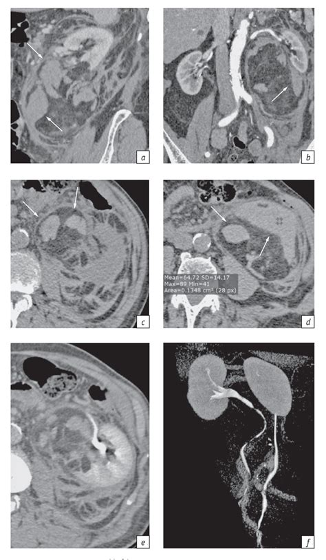 Figure 1 From Giant Renal Angiomyolipoma By The Example Of Clinical