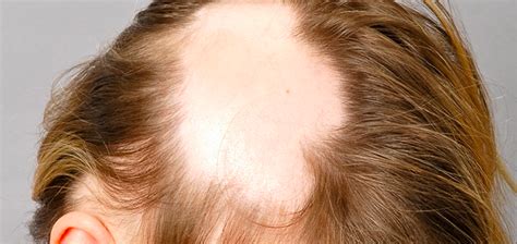 TREATMENT OF ALOPECIA AREATA UNIVERSALIS - Cubaheal