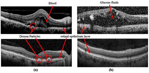 Choroidal Neovascularization Oct