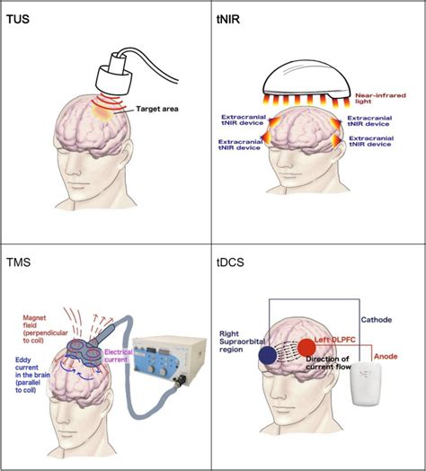 Comparing Transcranial Direct Current Stimulation Tdcs With Other Non