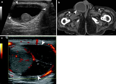 Pampiniform Plexus Ultrasound