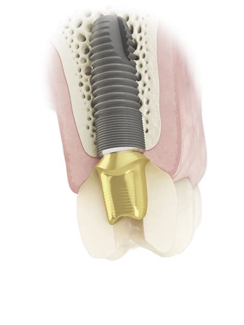 Dentsply Sirona Implant Supporting Full Implant Treatment Process