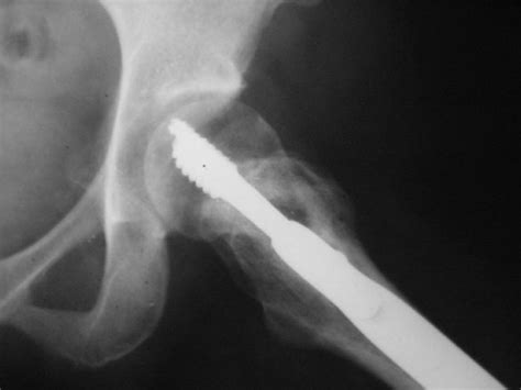 Non Union Fracture Neck Of Femur