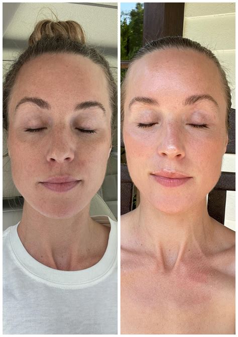 My Moxi Laser Treatment Review With Before Afters Natalie Yerger