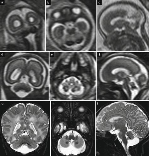 Congenital Infections Radiology Key