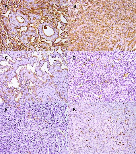 Immunohistochemical Features A And B CD31 Positive In Blood Vessels