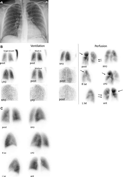 Ventilation Perfusion Scan A Primer For Practicing Radiologists