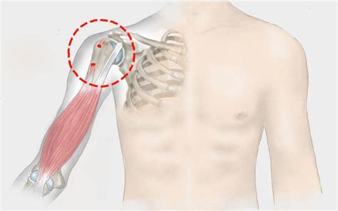 Bizepssehnenriss Anzeichen Behandlung Prognose