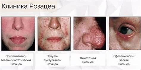 Розацеа | Дерматолог в Виннице