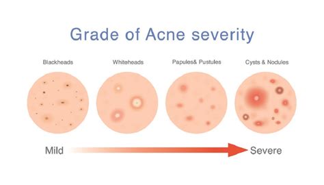 What Is Acne Symptoms Causes Treatment Metropolitan Skin Clinic