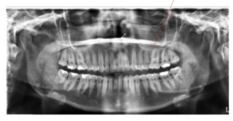 Dental Radiology Panoramic Landmarks Flashcards Quizlet