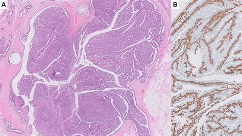 Papillary Neoplasms Of The Breastreviewing The Spectrum Modern Pathology