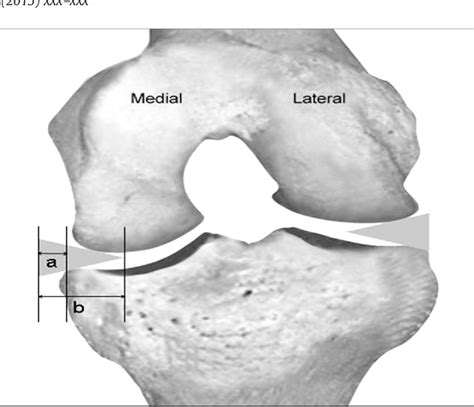 Figure From A New Arthroscopic Classification Of Degenerative Medial