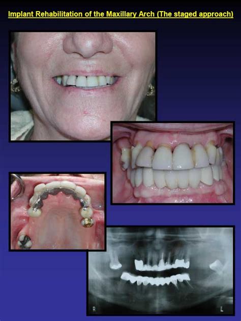 Affordable Dental Implants Dental Care Of Greensboro NC