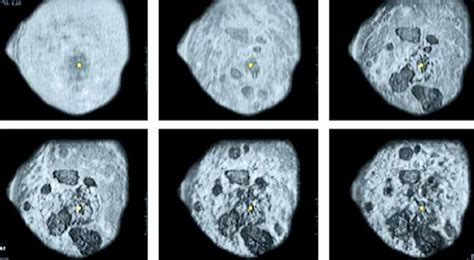 Automated Breast Ultrasound Data Coronal Projection Multiple